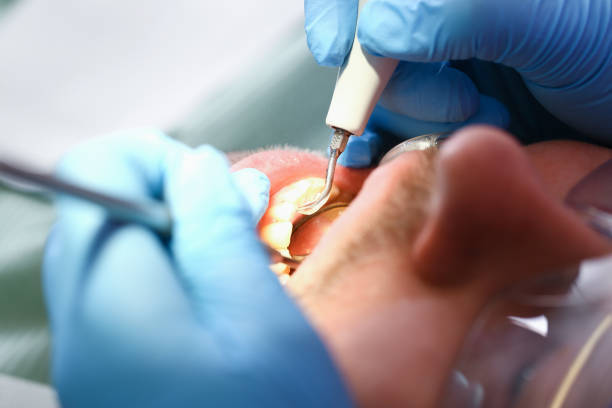 Best Emergency Root Canal Treatment in Bren Arrow, OK