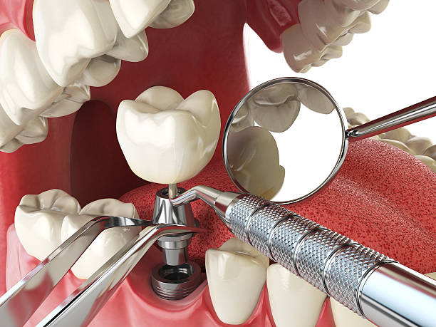 Best Emergency Wisdom Teeth Removal in Bren Arrow, OK