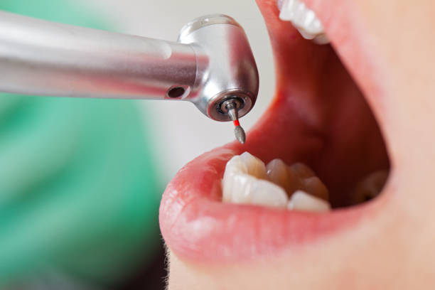 Best Emergency Wisdom Teeth Removal in Bren Arrow, OK
